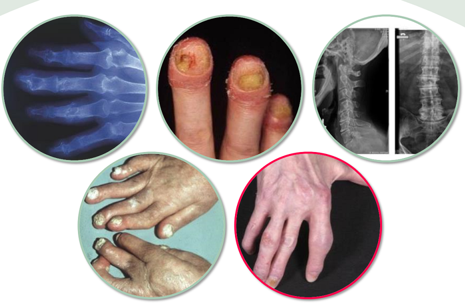 Brote artritis psoriásica